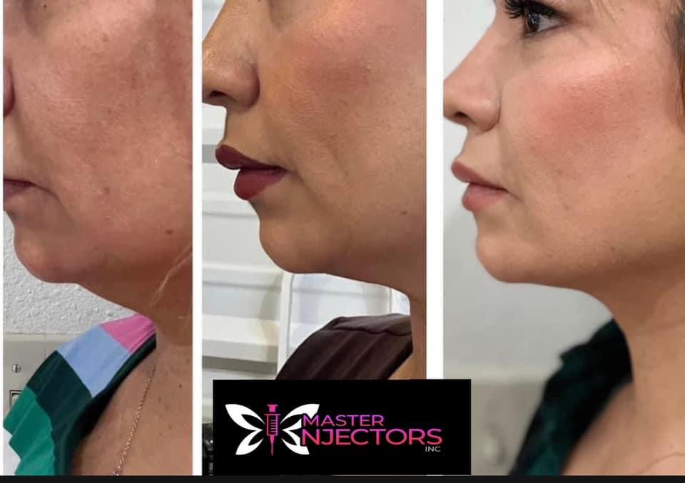 $325 Lipo- Dissolve Chin