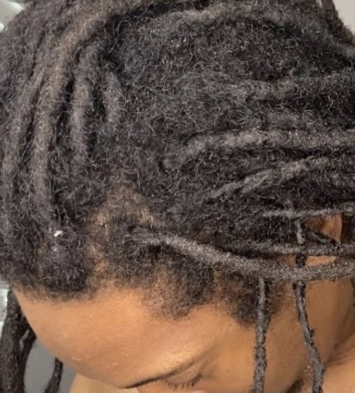 Matte separation AKA Loc Surgery