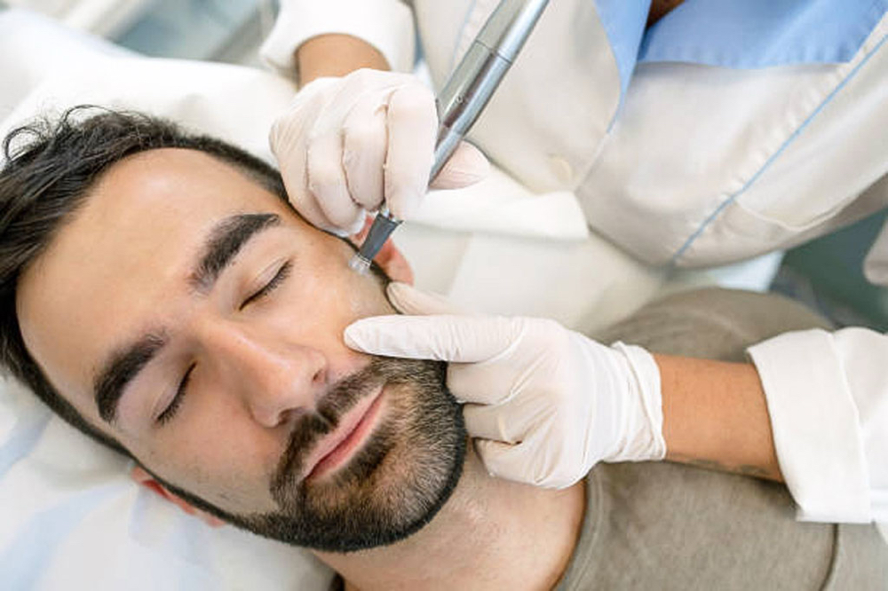 Micro Needling