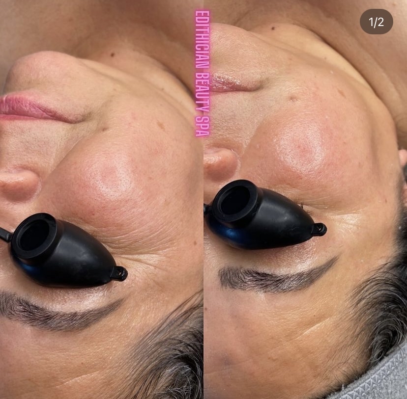 Anti-Aging Facial (Botox Mask)