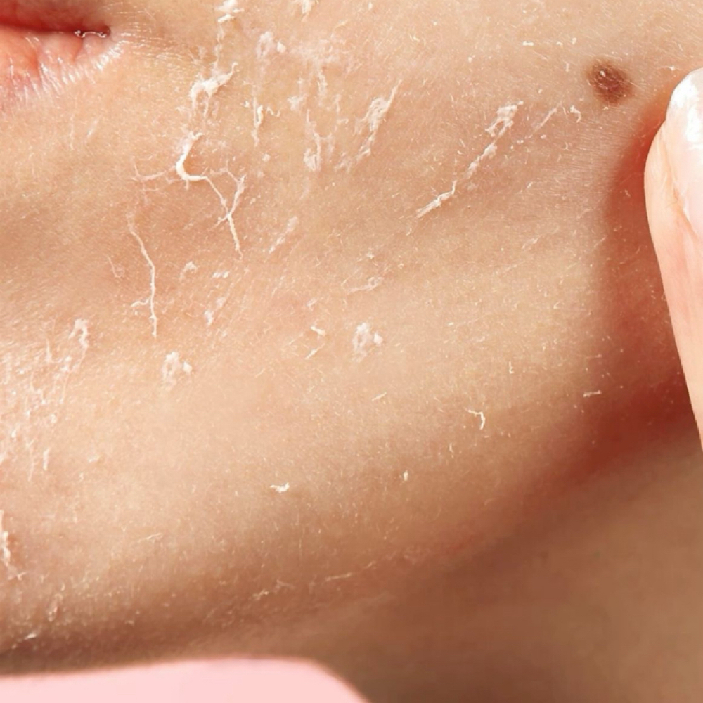 Chemcia Peel Series Of 3 at Rose Beauty Bar in Grants Pass, OR