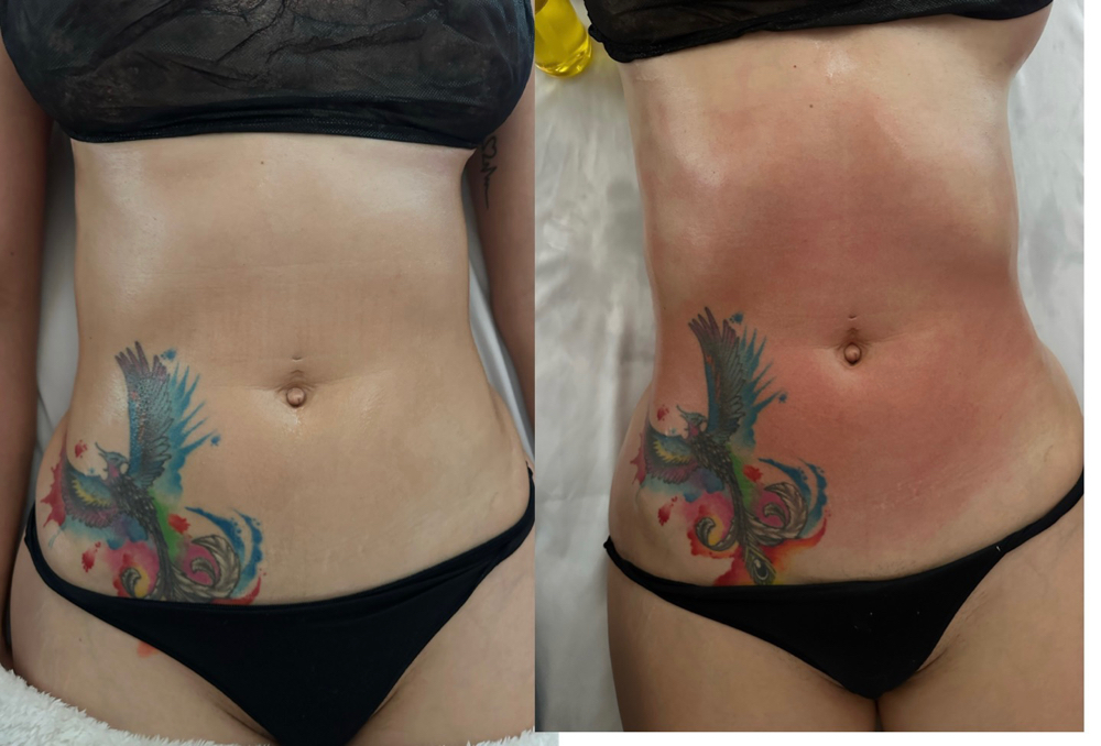 3 Abd,Waist,Back Maderotherapy