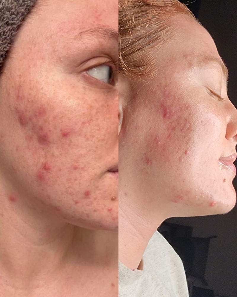 Acne Clarifying Treatment