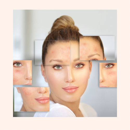 Clear Skin Acne Facial