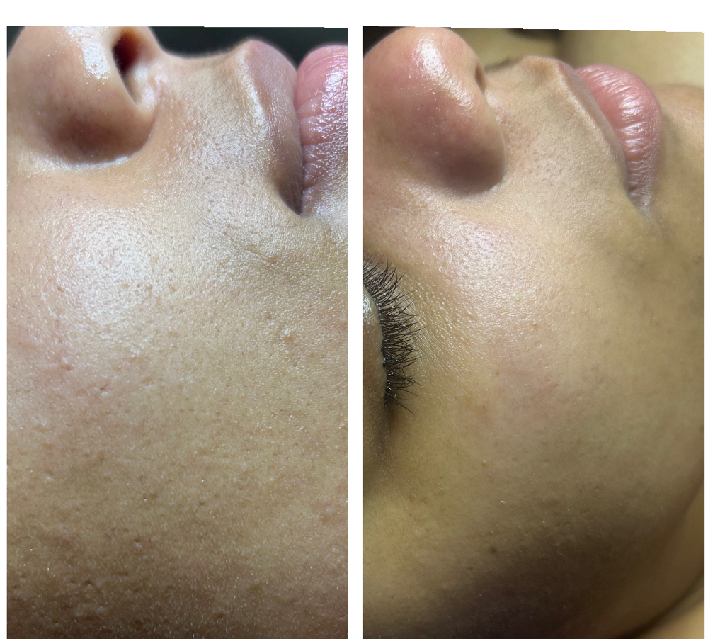 Dermaplane Facial