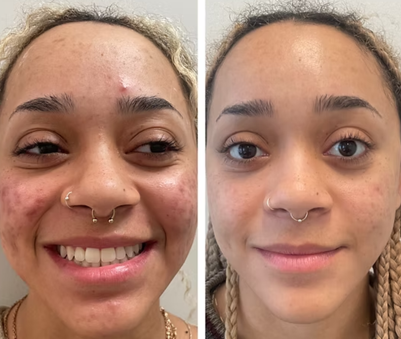 Acne Rescue Maintenance