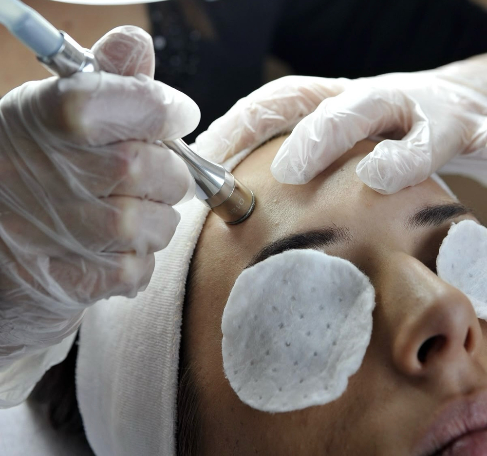 Microdermabrasion Facial