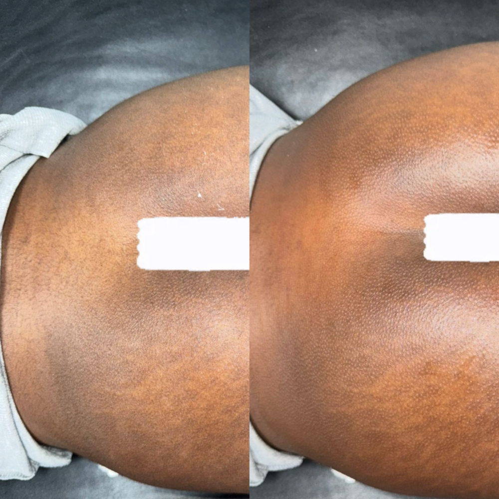 Brazilian + Full Butt + Lower Back at CM BEAUTY BAR in Housto, TX