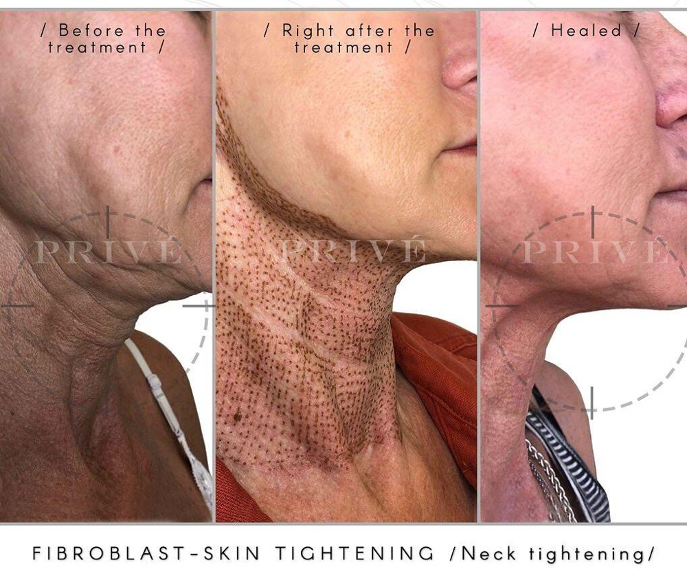 Fibroblast Neck Lift