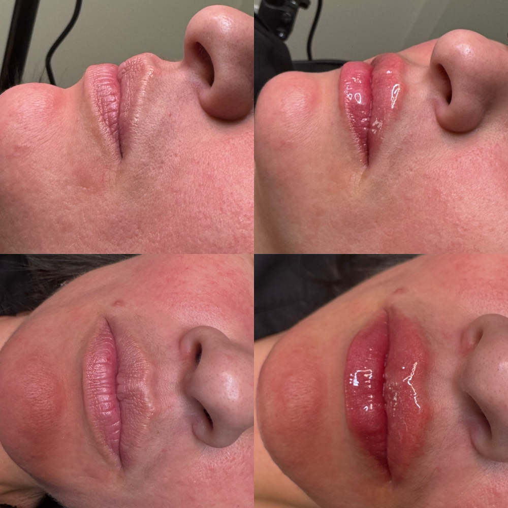 Lip Filler 0.7 mL Syringe