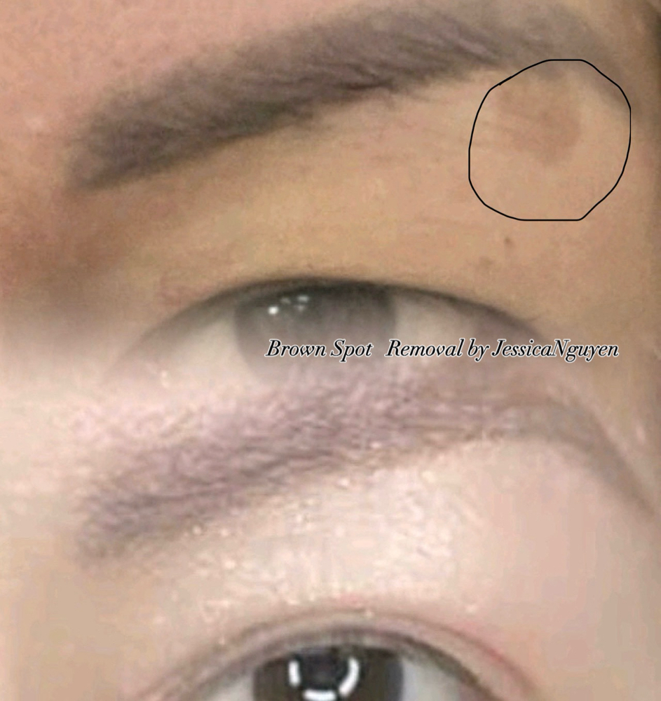 Melasma Removal