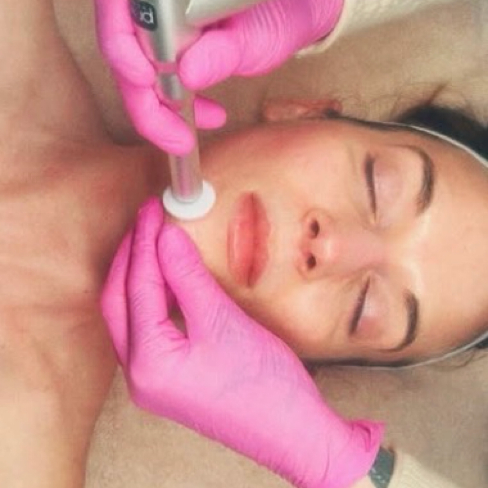 Microchanneling at Skin Sanctuary by Alison in North Little Rock, AR
