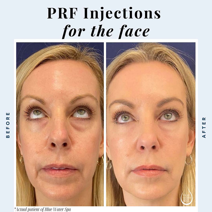 Facial Injections  PRF X 1