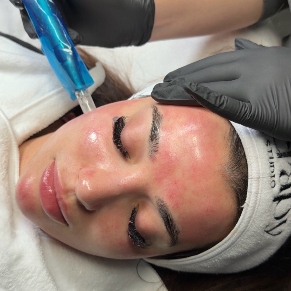 Microneedling at Skin Therapy in Golden valley, MN