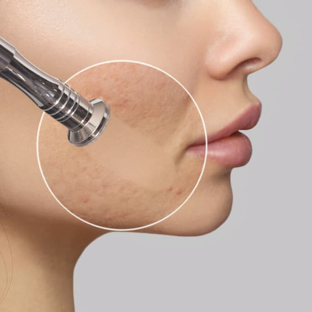 Microdermabrasion Facial at Bare by Lanna in North Reading, MA