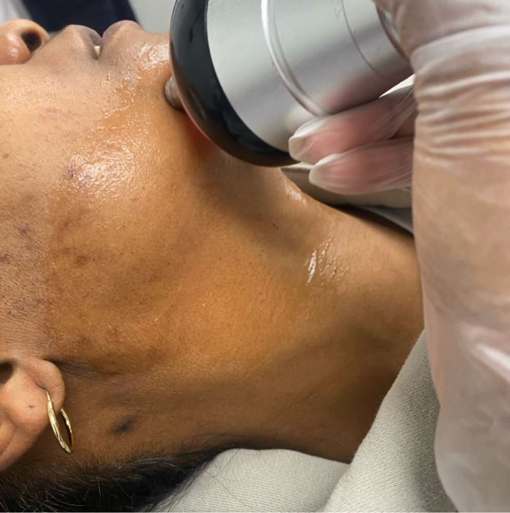 Facial Rejuvination at Eximius Bella in Garner, NC