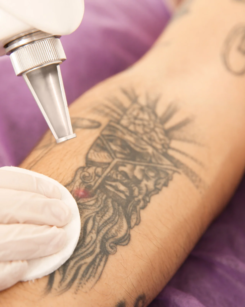Medium Area Tattoo Removal at M.A.V Aesthetics in Fort Morgan, CO