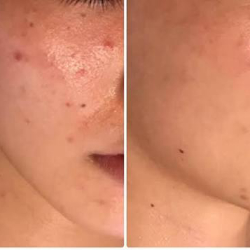 Teen Acne facial at Haus of Beauty Studio in Hialeah, FL