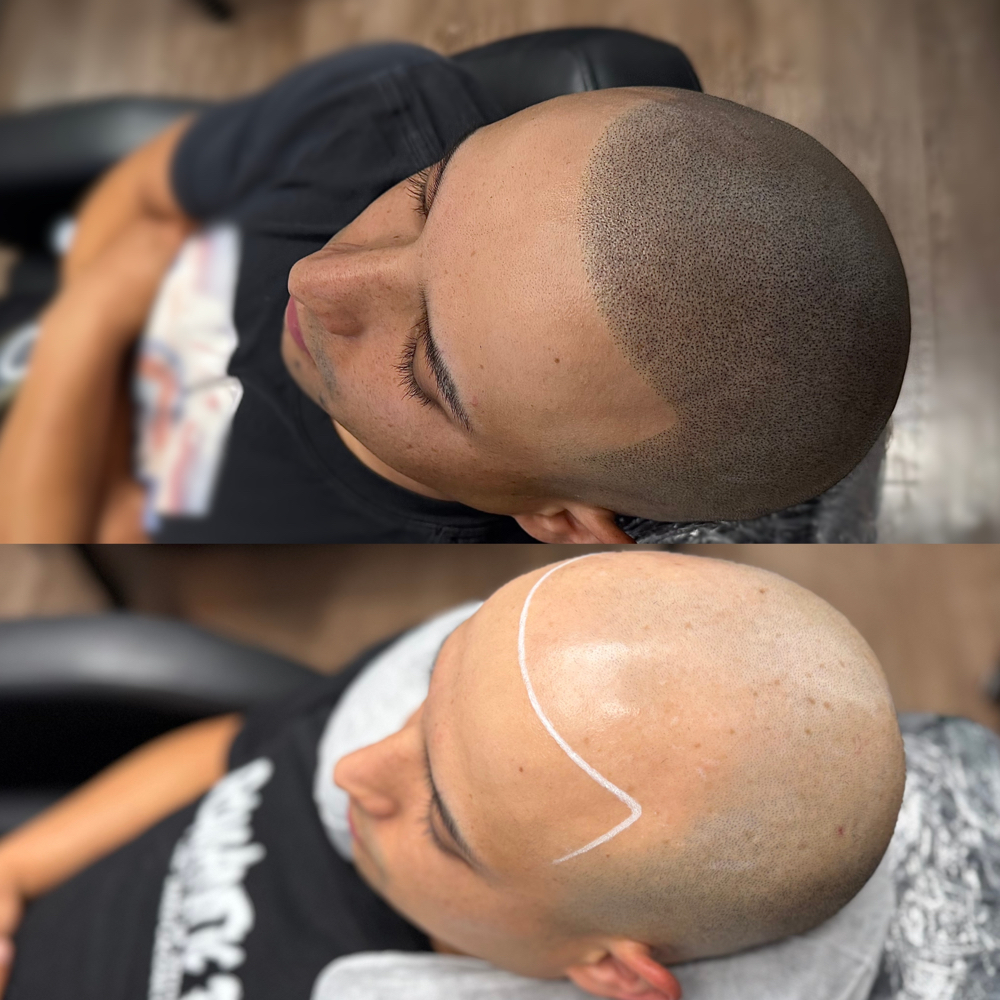 Scalp Micropigmentation Hairline Restoration