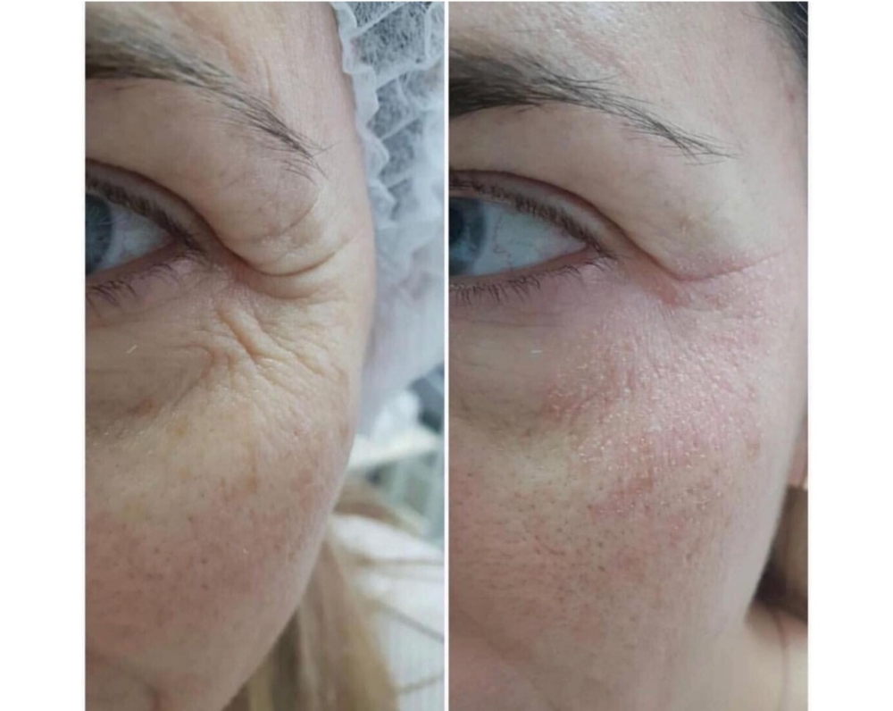 Cold plasma around the eyes