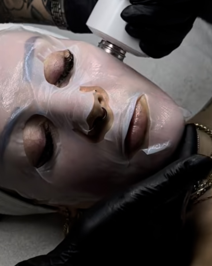 Microneedling X Glacial at VOGUE AESTHETICS in Okeechobee, FL