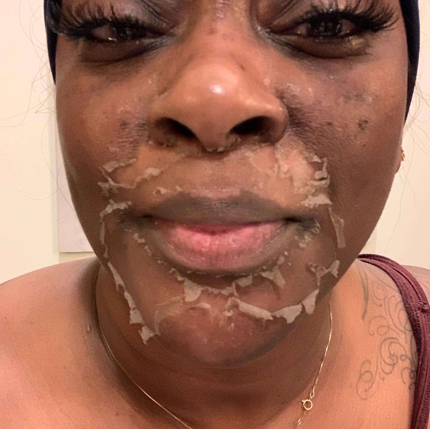 My Skin Is So Sensitive Peel