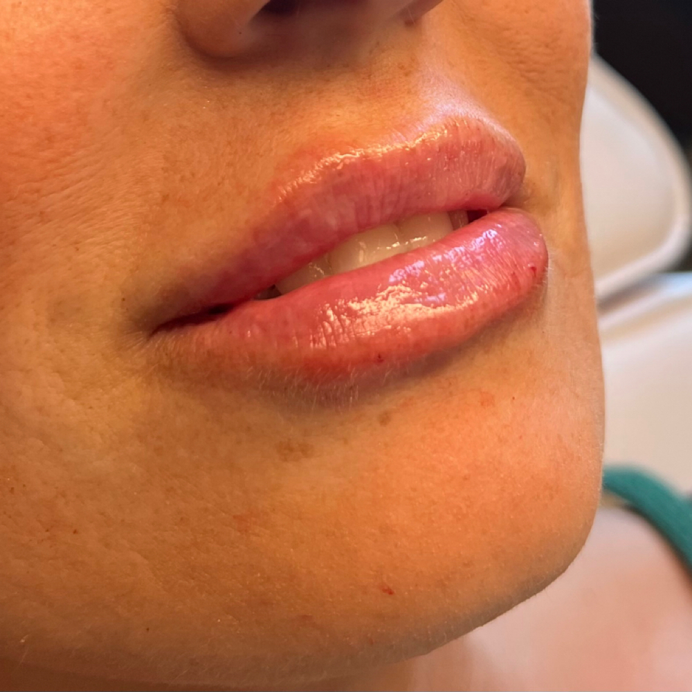 Lip Filler at Blurred Lines Aesthetics LLC in Waxahachie, TX