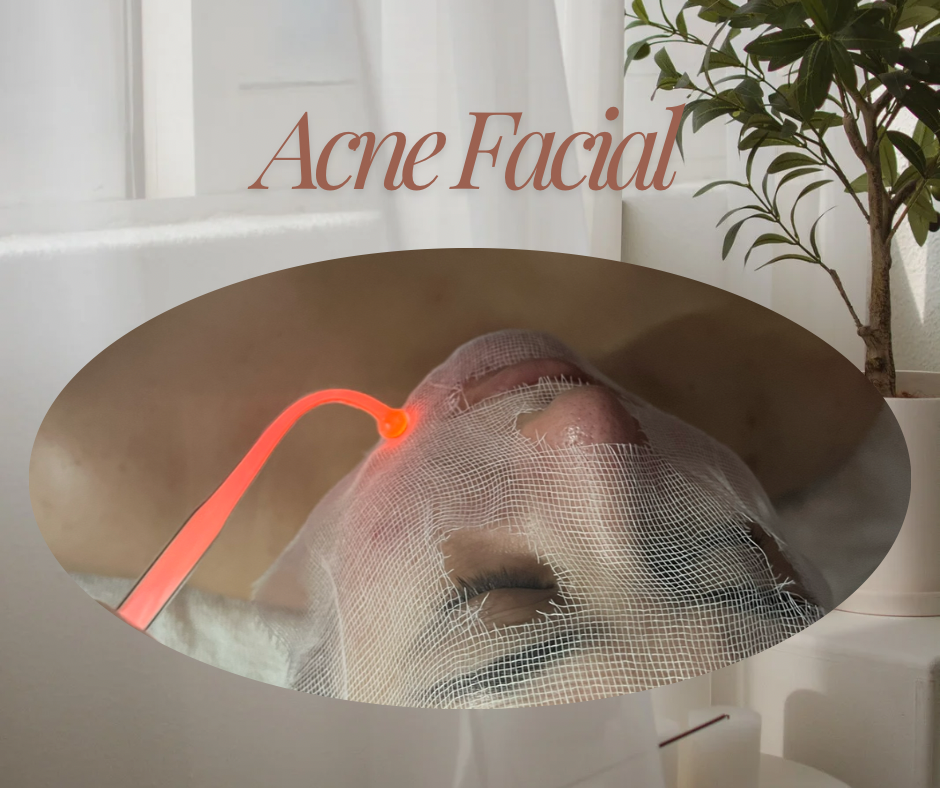 ACNE FACIAL