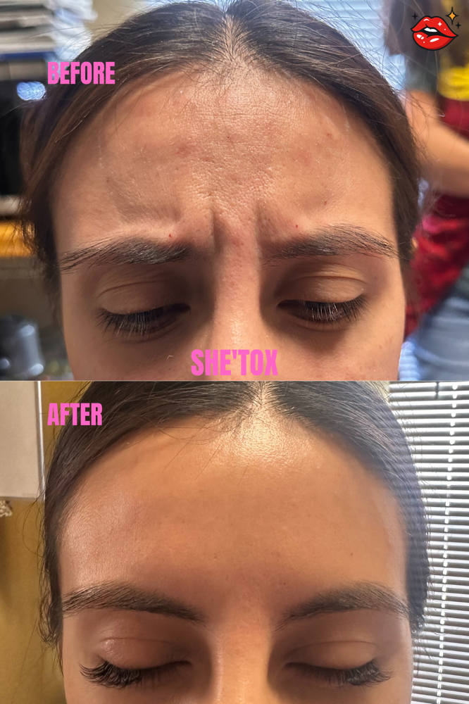 Neurotoxin (Botox)