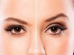 Brow Lift