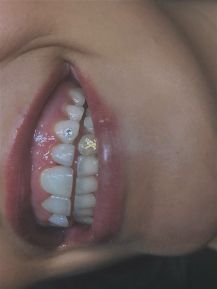 Gold/Silver Add On Tooth Gem