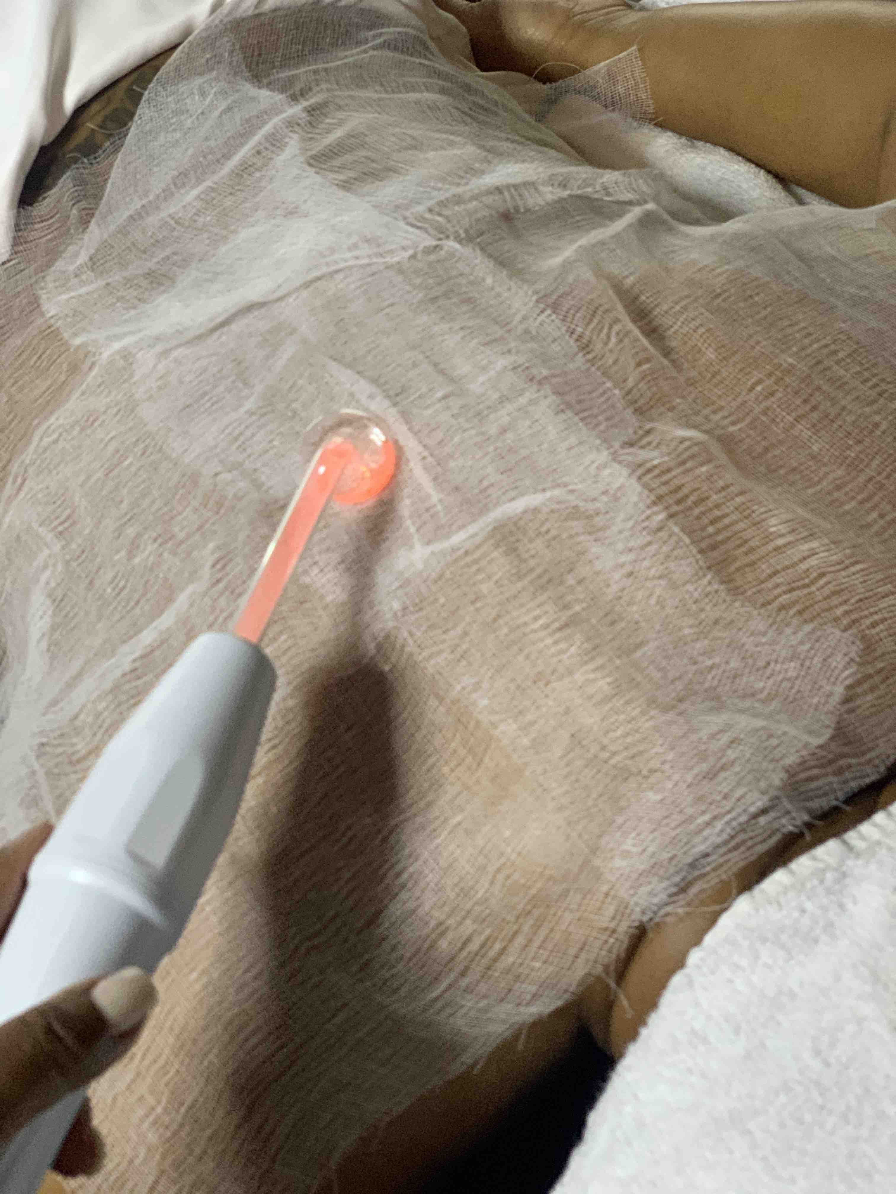 High Frequency Treatment