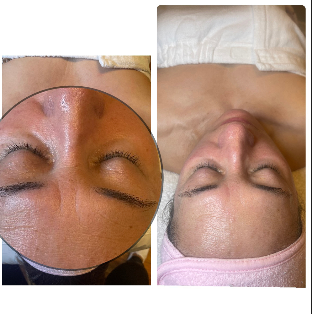 Nano Needling