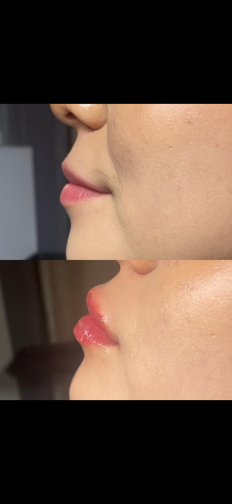 Lip Filler TOUCH UP
