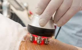 Radiofrequency Skin Tightening