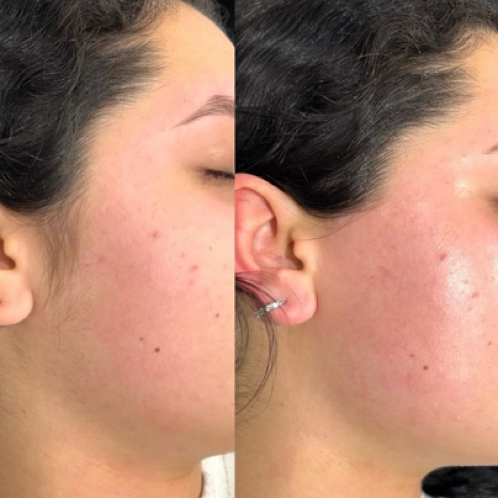 Cheeks Wax at LauLux Esthetics in Bellerose, NY