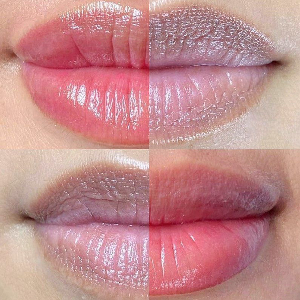 LIP NEUTRALIZATION at Vanessa Yarce in Miami, FL