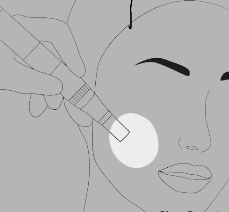 Microneedling with Radio Frequency