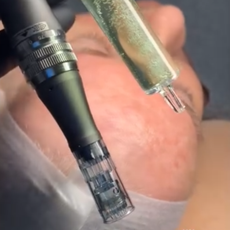 Microneedling w/Radio Frequency
