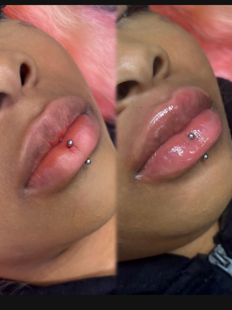 Lip Filler 💋 (needle-less) at Studio E11even Beauty Co in Milwaukee, WI