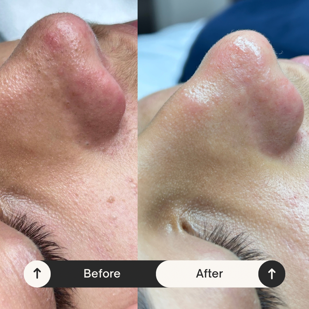 teen Detox at LucentSkin Facial Studio in Roswell, GA