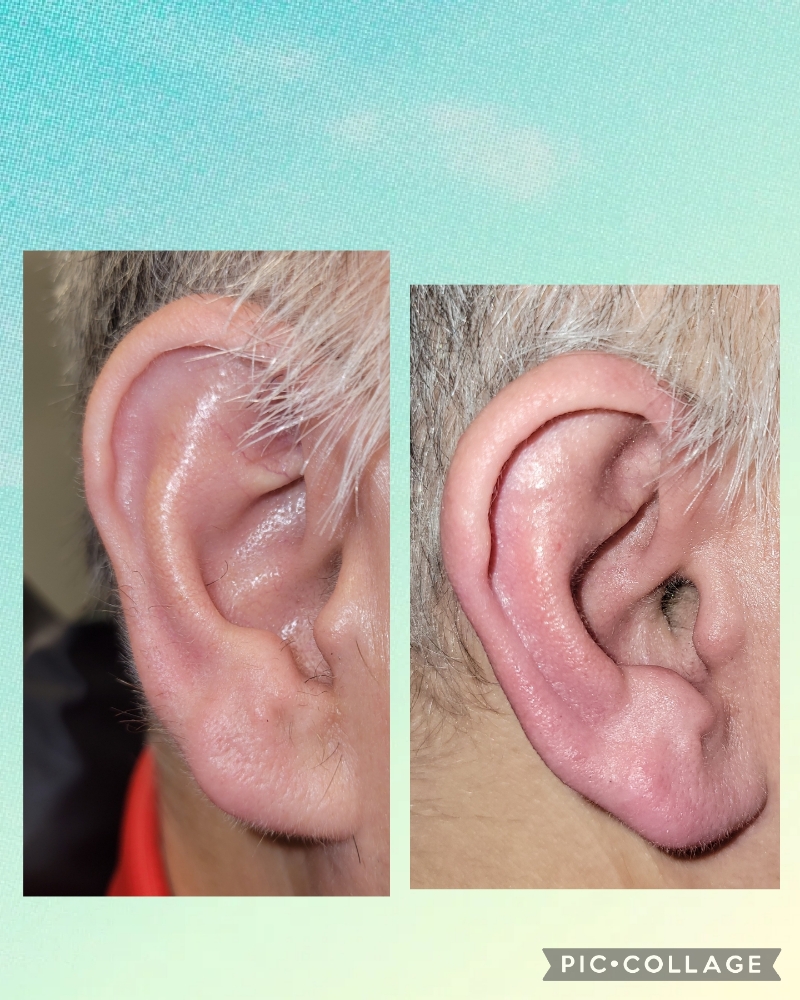 Ear Wax