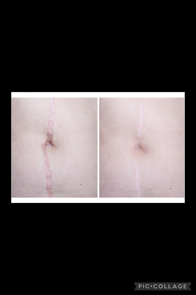 Scar Revision