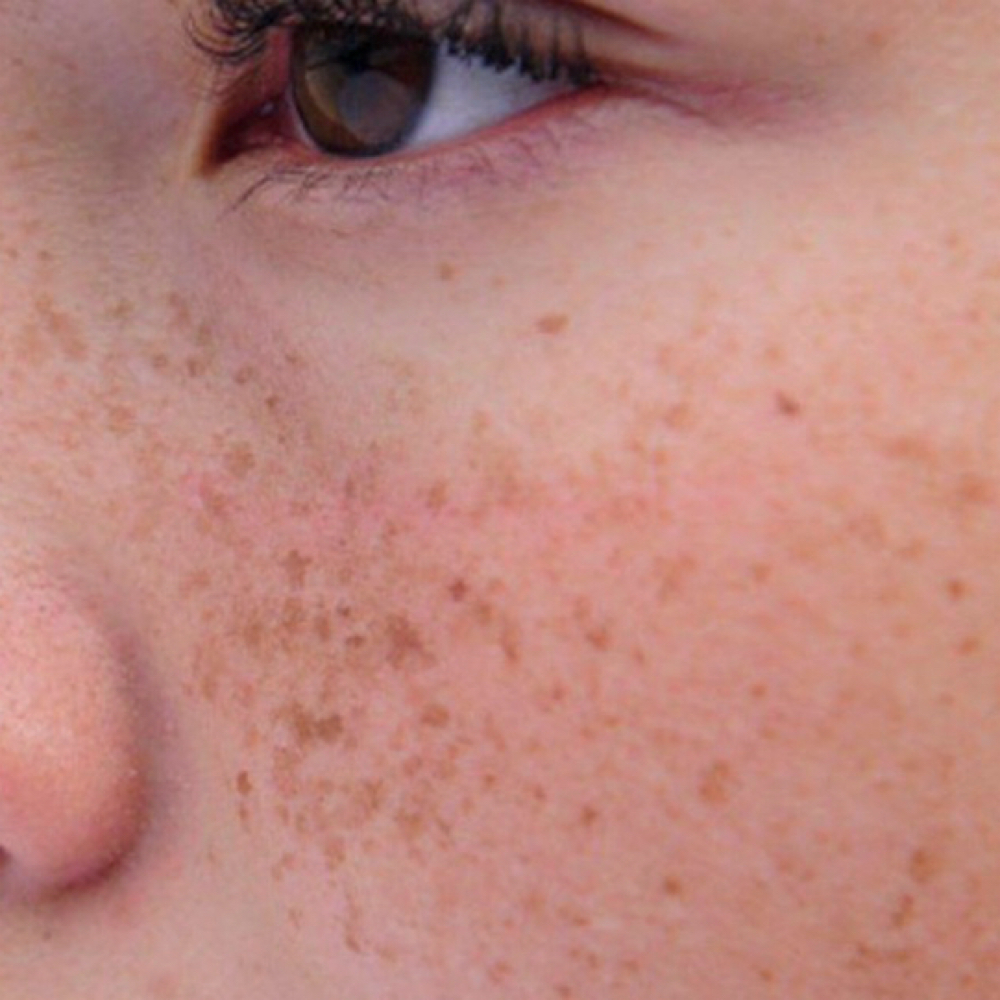 Freckles-Sardas (6) at La Belle Studio by Soraya in Woburn, MA