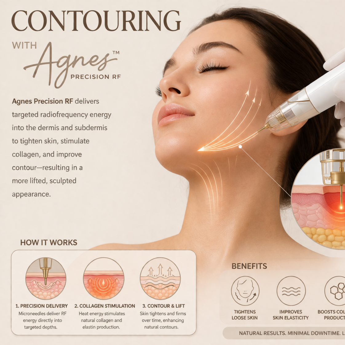 CONTOURING -AGNES Precision RF at America Medical Esthetics Services in Santa Ana, CA