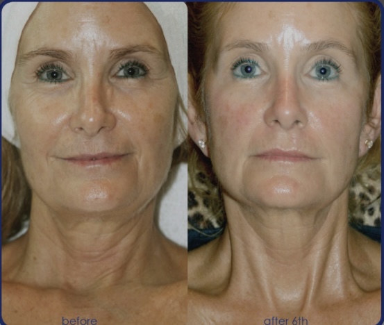 Switch Dermal Rejuvenation