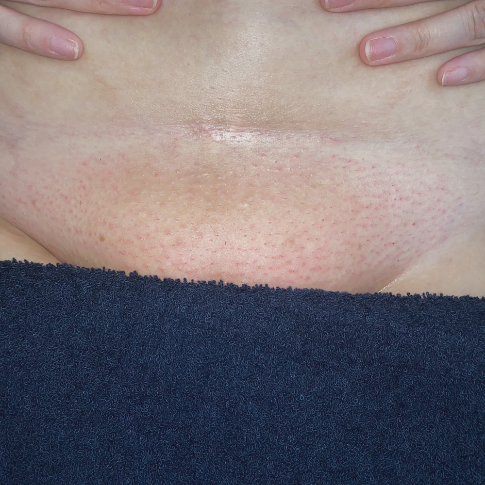 Brazilian Wax (1st Brazilian/6+ Wk)