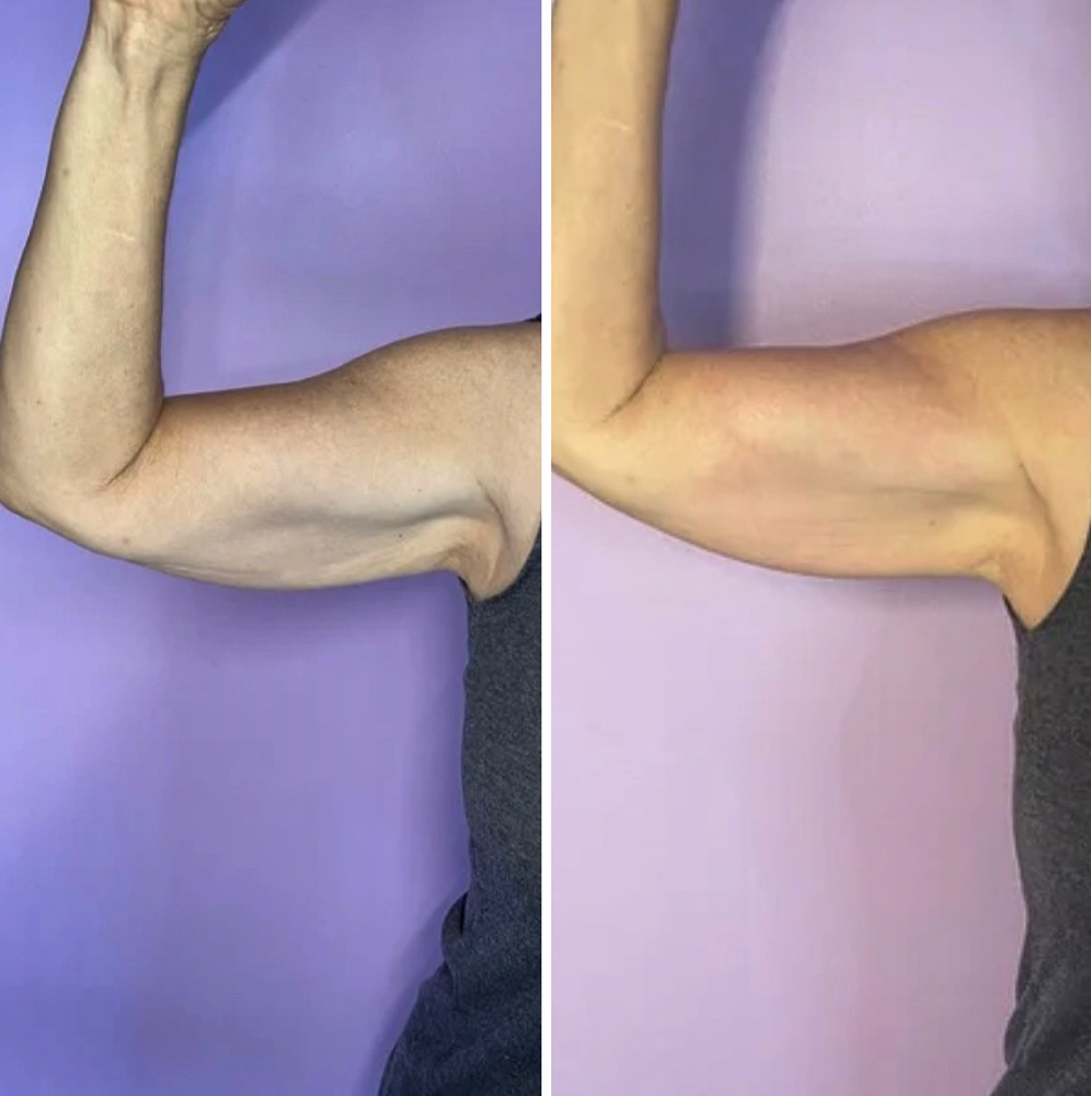 Arm Sculpting