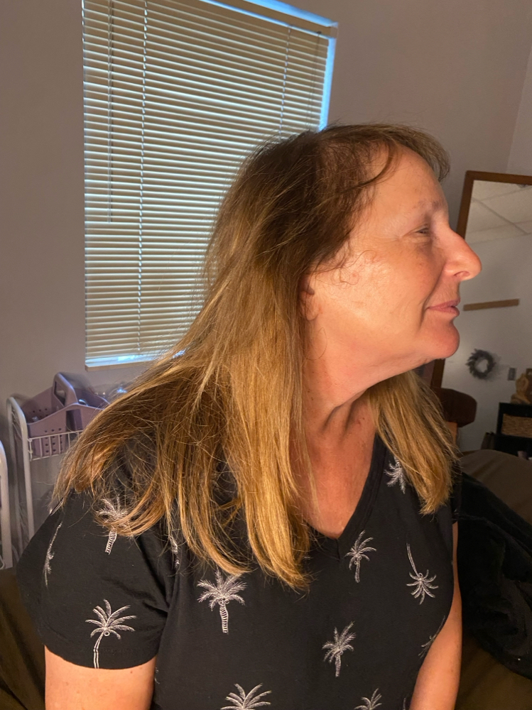 Rf Facial at LuxBeautique in Pawtucket, RI