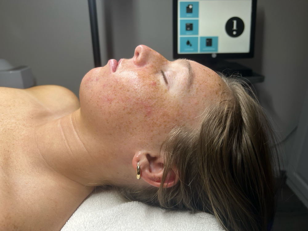 Deluxe HydraFacial